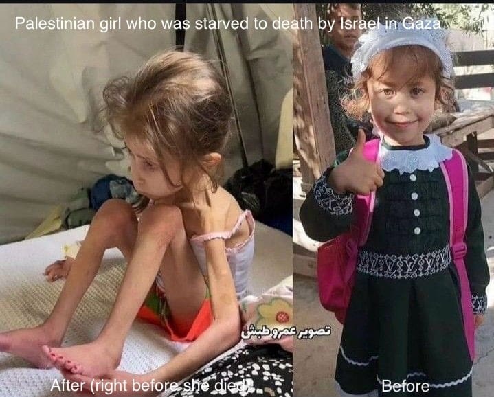 Children shot in Gaza. A little girl suffering from malnutrition due to starvation.